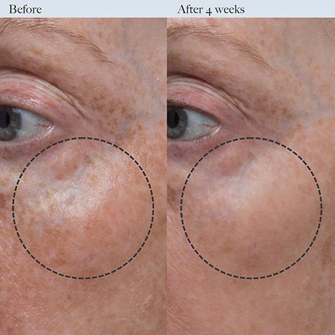Image 1 - A side-by-side comparison of a persons skin around the eye area showing visible improvements after four weeks of treatment, with the left labeled Before and the right labeled After 4 weeks.
Image 2 - Image comparison showing the left side labeled Before with a close-up of textured skin, and the right side labeled After 4 weeks displaying smoother skin in a similar area, with each side encircled by a dotted line.
Image 3 - An image showing two cream-like textures with a transparent packet in the background, along with text that reads: Key Ingredients. 0.5% Retinol A type of retinoid (Vitamin A) that visibly improves loss of firmness and reduces the appearance of fine lines, wrinkles, and uneven skin tone. Bioidentical Skin Lipids Hydrate skin by mimicking naturally occurring ceramides (aka lipids) to fortify skins natural moisture barrier.