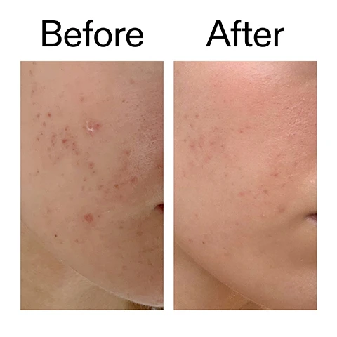 Image 1 - A before and after comparison showing a close-up of skin, with the left image displaying noticeable acne and redness, and the right image showing significantly clearer and smoother skin with reduced redness, labeled Before and After. Image 2 - A close-up of a persons face, showing their eyes and the skin around them which appears textured, with text that reads 94% agreed the appearance of post breakout and blemish dark spots are significantly reduced* *Based on an independent clinical trial under dermatological control, 20 participants, October 2021. Image 3 - A close-up of a smiling face with glowing skin, showcasing shiny lips and white teeth, accompanied by the text Why we love it, which lists: Lightweight, non-sticky formula; Exfoliates to smooth & brighten skin tone; Visibly reduces post-acne marks and pigmentation. Image 4 - The image features a creamy yellow product smear on a white background alongside text that reads: Why it works, 10% Mandelic Acid REDUCES DARK SPOTS, HYPERPIGMENTATION AND POST-ACNE MARKS., 0.1% Retinol FADES DISCOLORATION., Glycerin DEEPLY HYDRATES SKIN. Image 5 - A hand squeezes a small white tube of The INKEY List Mandelic Acid Treatment, dispensing a small amount of product onto a fingertip, with instructions above that read: How to use USE A THIN LAYER IN THE PM. PAT ONTO TARGETED CONCERN AREA. AFTER CLEANSER, BEFORE MOISTURISER. ALWAYS APPLY SPF IN THE AM. The tube itself displays MANDELIC ACID TREATMENT 0.5 US fl.oz / 15ml e Helps reduce the appearance of hyperpigmentation and discoloration Aide à réduire lapparence de lhyperpigmentation et des décolorations THE INKEY LIST™. Image 6 - A creamy yellow textured background with text that reads: How to layer your routine, and a numbered list: 1 CLEANSE, 2 HYDRATE, 3 TREAT, 4 MOISTURISE, 5 SPF, with the number 3 highlighted in a black circle.