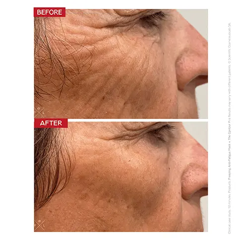Image 1, U AFTER BEFORE Clinical case study, 10 minutes. Products: Freezing Anti-Fatigue Mask + The Cpntour Pro Results may vary with different patients. Scientific Cosmeceuticals SA. Imsge 2, BEFORE AFTER 10 MIN Usage: The Contour Pro with Freezing Anti-Fatigue Mask Results may vary with different patients