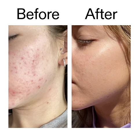 Image 1 - A before and after comparison shows a persons face with acne and redness on the left, and significantly clearer, smoother skin on the right, labeled Before After. Image 2 - A close-up shows a persons eyes with fingers applying a clear product to the skin beneath them. The visible text reads: Why we love it, Gentle enough for daily use, Lightweight and fast-absorbing, Reduces excess oil, blemishes and redness. Image 3 - A white background shows two translucent liquid droplets on the right, with text on the left that reads Why it works, 10% Niacinamide, REDUCES THE APPEARANCES OF EXCESS OIL, BLEMISHES AND REDNESS, Hyaluronic Acid, and HYDRATES AND PLUMPS SKIN. Image 4 - A close-up image shows a light pink drop of product falling from a black dispenser onto a finger, with instructions How to use USE AM/PM. 1-2 DROPS. PAT INTO FACE AND NECK. AFTER CLEANSER, BEFORE MOISTURISER AND SPF IN THE AM. Image 5 - A minimalist image with a wavy cream shape and two clear liquid drops shows the text How to layer your routine and a numbered list: 1 CLEANSE, 2 HYDRATE, 3 TREAT, 4 MOISTURISE, 5 SPF, with number 3 TREAT highlighted.