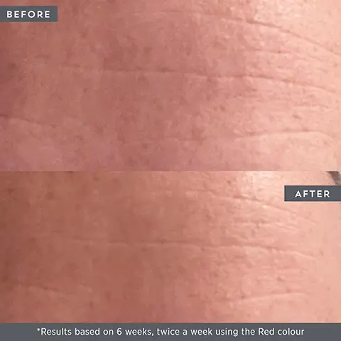 Before. After. Results based on 6 weeks, twice a week using the Red colour. 5 stars. LED wand. This is my favourite tool. I take it everywhere! Love that it comes with a travel bag and that it has 2 light settings. I use the red for my forehead to prevent wrinkles and the blue along my jawline to help with hormonal acne. Red led light therapy, helps promote youthful, radiant skin by stimulating collagen and improving tissue oxygenation that deeply rejuvenates while reducing the appearance of fine lines and wrinkles. Blue led light therapy, helps improve the appearance of existing blemishes while minimising future breakouts. Microcurrent, this non-invasive form of energy helps increase the effectiveness of skincares by boosting absorption of creams and serums into the skin. High frequency sonic vibration simulating a gentle facial massage the micro vibrations help increase oxygen to the skin to improve texture, tone and glow. Thermotherapy, this gentle, warming sensation relaxes the facial and under eye areas to help reduce puffiness. 5 stars LED wand, A really great way to try out LED without spending hundreds. I have found this wand really handy, I've definitely noticed that my skin feels more glowy. I enjoy taking time to relax in the evening while I use it.