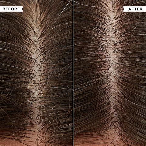 Image 1 - A split image showing a close-up of a scalp, with the left side displaying visible dandruff flakes and the right side showing a clean scalp, labeled BEFORE and AFTER. Image 2 - A white Philip Kingsley Anti-Dandruff Shampoo bottle with a pump dispenser and two clear bubbles of product are shown next to text stating 100% reported it SOOTHED their scalp* and 99% reported it CLEARED their flaky scalp*, with the bottle label reading FLAKY / ITCHY SCALP Refreshes, calms and comforts the scalp Remplissit, apaise et soulage le cuir chevelu ANTI-DANDRUFF SHAMPOO SHAMPOOING ANTI-PELLICULAIRE 1000ml 33.8fl oz, and the fine print at the bottom states *95 PERSON INDEPENDENT CONSUMER PERCEPTION TRIAL ALL PARTICIPANTS SUFFERED WITH DANDRUFF/FLAKY/ITCHY SCALP. Image 3 - A hand holds a large white Philip Kingsley anti-dandruff shampoo bottle with a green label, while text to the right lists its benefits: KEY BENEFITS, Provides instant relief for itchy, irritated scalps, Clears flaking and oil build-up, Safe for colour-treated hair and gentle enough for daily use, and text on the bottle reads PHILIP KINGSLEY, FLAKY / ITCHY SCALP, Relieves, calms and comforts the scalp, ANTI-DANDRUFF SHAMPOO, SHAMPOOING ANTI-PELLICULAIRE, 1000ml 33.8fl oz. Image 4 - A hand holds a white pump bottle of Philip Kingsley Flaky / Itchy Scalp Conditioner 1000ml, while another hand holds a dollop of white conditioner, next to a customer review that reads After using this conditioner my hair felt amazing. Clean, SOFT and SILKY and NO DANDRUFF. CUSTOMER REVIEW. Image 5 - A green background displays a bulleted list of benefits with checkmarks, stating KEY BENEFITS: Intensely nourishing, Suitable for limp and oily hair, Doesnt weigh hair down.